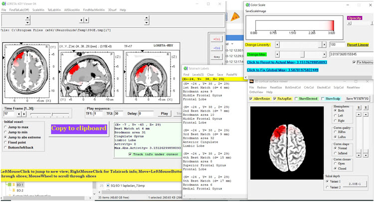Figure 19 - Post-neurofeedback eyes-closed z-score LORETA analysis for 17 Hz showing reduced excess